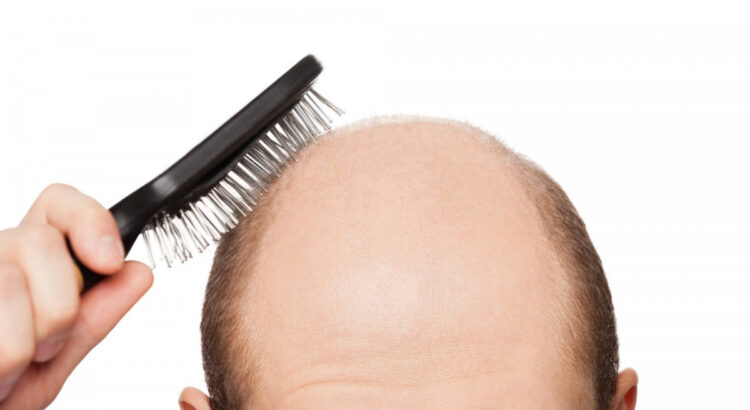 Saç dökülmesi nedenleri ve tedavi yöntemleri
